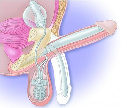 Eine Penisprothese stellt die Erektion wieder her und vergrößert den Penis